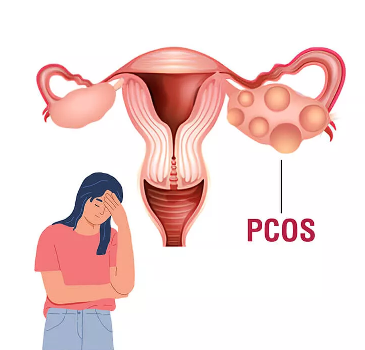 PCOS تخمدان پلی کیستیک و ریزش مو